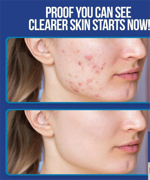 CeraVe Resurfacing Retinol Serum 30ml – For Post-Acne Marks | Niacinamide & Licorice Root | Brightening & Pore Minimizer
